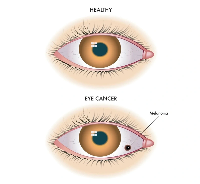 ilustrasi kanker mata